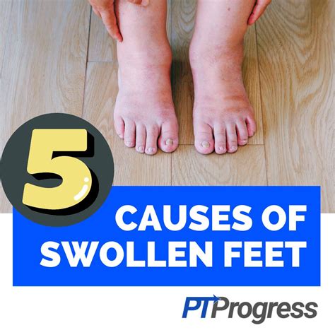 5 Reasons You Have Swollen Feet and Ankles