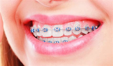 Types of Braces | Central Missouri Orthodontics