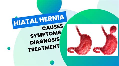 Hiatal Hernia (Causes, Symptoms, Diagnosis, Treatment) - Chiropractor ...