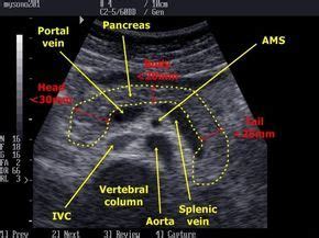 Long Pancreas w/vascularity labeled (With images) | Ultrasound ...