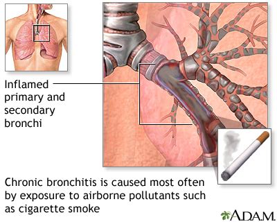 Bronchitis - acute Information | Mount Sinai - New York