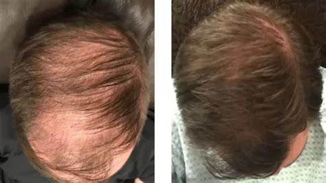 Minoxidil Before and After Photos [2022] | Is it right for you?