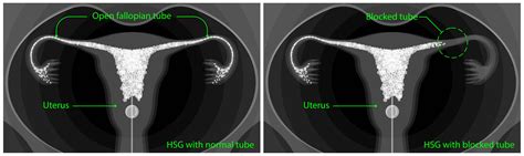 Hysterosalpingogram (HSG) test for Fallopian Tubes