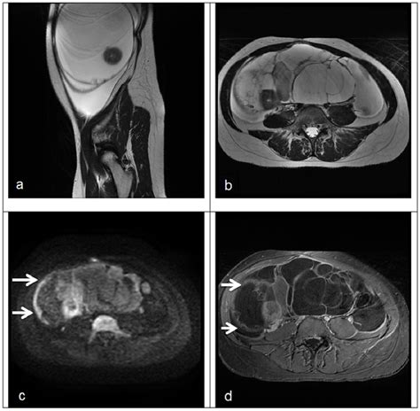 Figure 1 from MRI features of primary and metastatic mucinous ovarian ...