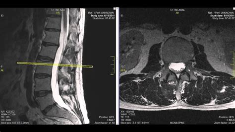 Normal Lumbar Spine MRI Explained | Dr. Jeffrey P. Johnson | HD - YouTube