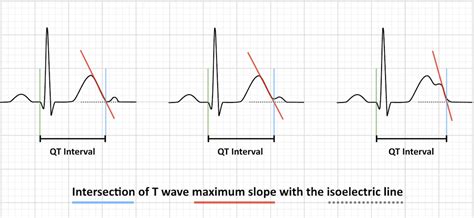 QT Interval • LITFL • ECG Library Basics