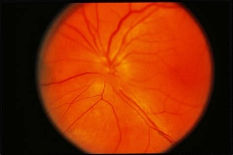 Choroidal Hemangioma / RD - Retina Image Bank