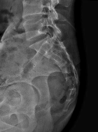 Sacrum Anatomy Xray