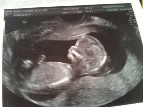 12 weeks scan pics with confirmed gender | BabyCentre