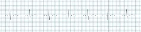 Normal Sinus Rhythm • LITFL Medical Blog • ECG Library Basics