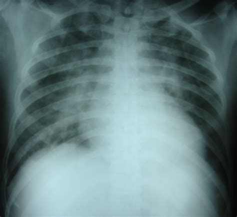 Chest X-ray supine view with pulmonary congestion – All About ...