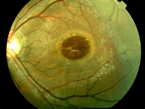 Posterior Vitreous Detachment | Retina Consultants of Nevada - Retina ...