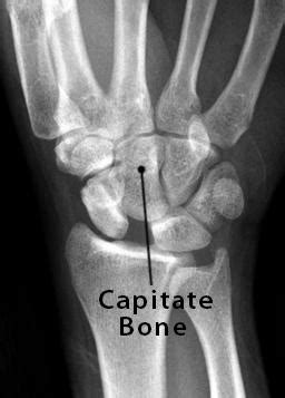 Capitate Bone Definition, Location, Anatomy, Diagram