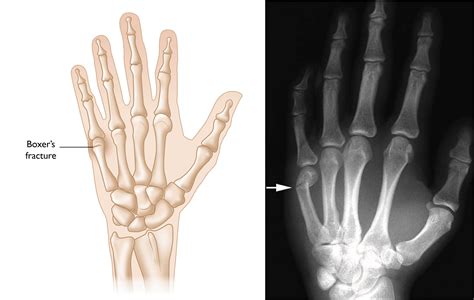 Broken Middle Finger X Ray