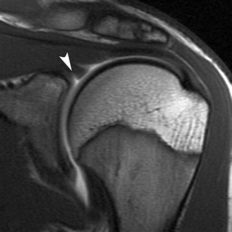 Mri Shoulder Labrum Tear