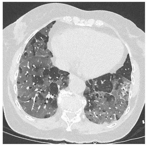 JoF | Special Issue : Fungal Infections Complicating COVID-19