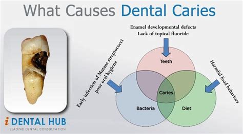 Know about the causes of dental caries | Dental Care @ Identalhub | P…