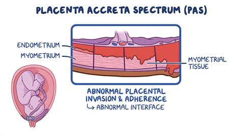 Placenta accreta spectrum: Clinical sciences - Osmosis Video Library