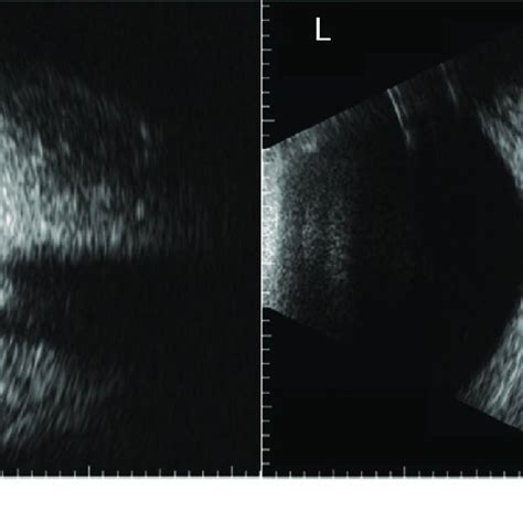 (PDF) Usefulness of B-scan ocular ultrasound images for diagnosis of ...