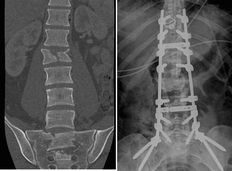 Thoracolumbar-pelvic Fixation for Concomitant Sacral and Lumbar ...