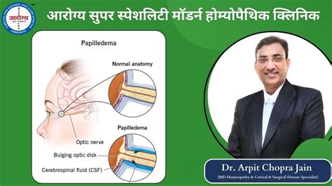 Papilledema treatment at Dr. Arpit Chopra Jain's Aarogya Super ...