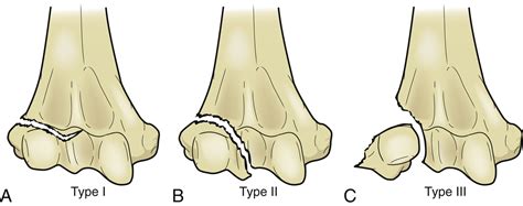 Reduction and Fixation of Lateral Condyle Fractures of the Distal ...