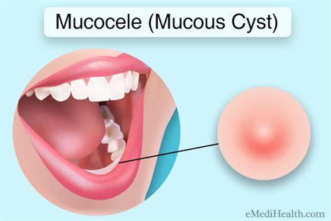 Mucocele: Diagnosis, Treatment, and Self-Care Tips