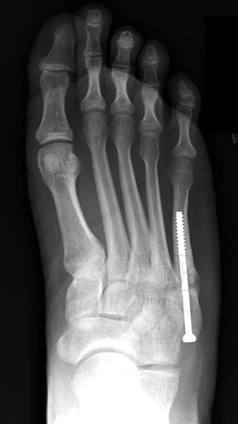 4 Types of Fifth Metatarsal Fracture | Metatarsal fracture, Bone ...