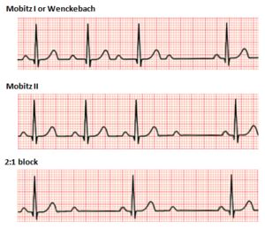 Second-degree atrioventricular block - WikiVisually