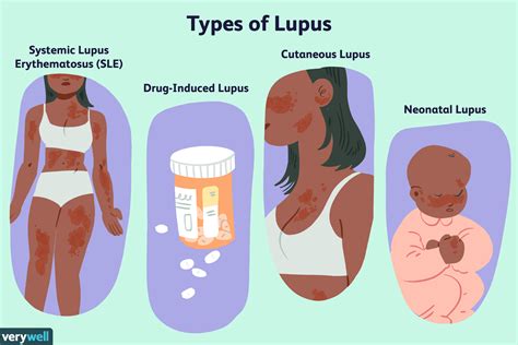 Lupus Treatment Options