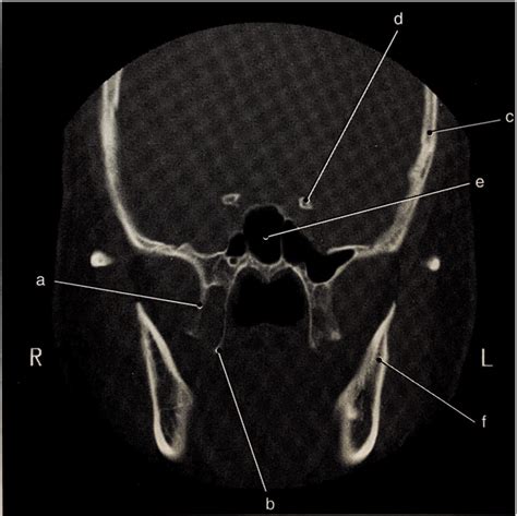 coronal CT of sphenoid bone Diagram | Quizlet