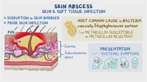 Staphylococcus Aureus Infection Symptoms