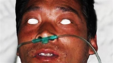 Tragic Tale Of Hisashi Ouchi: Radiation Poisoning's Gruesome Toll