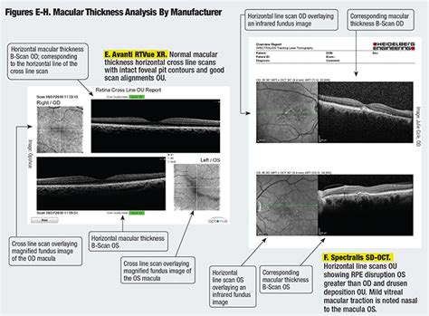 The Anatomy of an OCT Scan