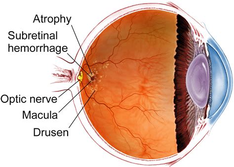 Age-related Macular Degeneration - The American Society of Retina ...