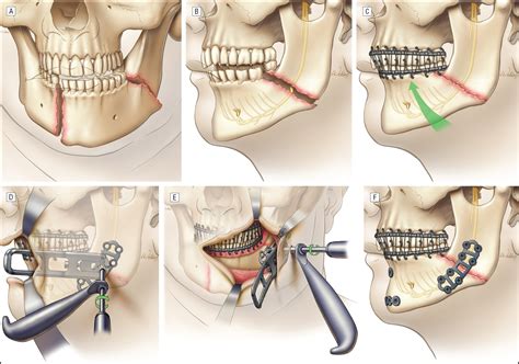 Top.of Jaw Is Fractured What Is Treatment