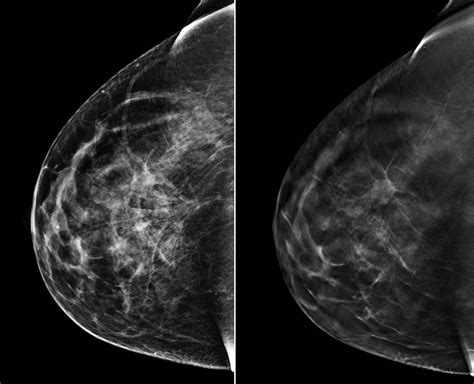 3D mammography proves highly effective in detecting cancer | health enews