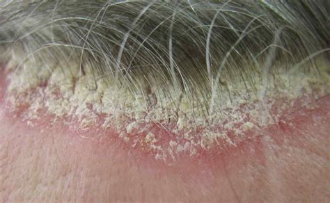 Scalp psoriasis scales pictures | Symptoms and pictures