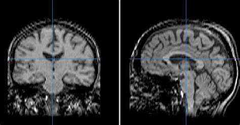 MRI and MS: 7 things you need to know | MS Society