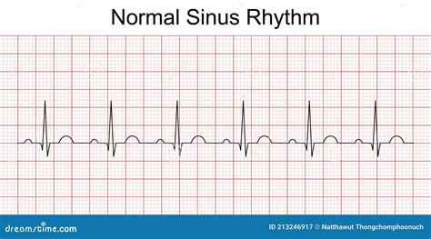 Eletrocardiograma Mostra Ritmo Sinusal Normal Da Linha Do Batimento ...