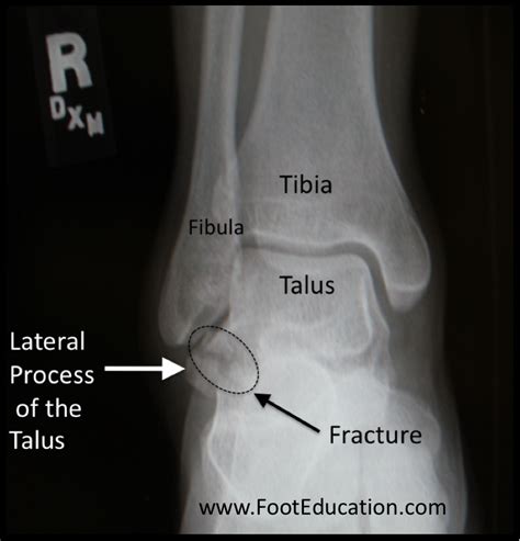 Lateral Talar Process Fractures - FootEducation