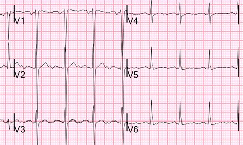 Dr. Smith's ECG Blog: Adding to the many faces of Hypokalemia....