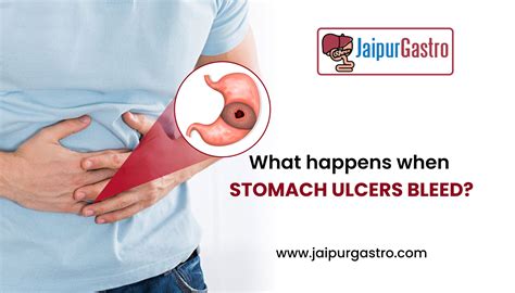 What Happens When Stomach Ulcers Bleed? - Dr. Shankar Dhaka