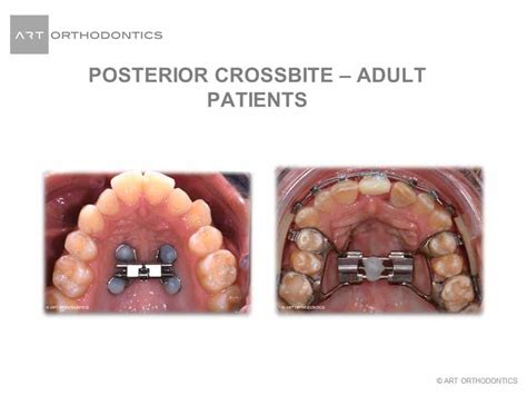 Crossbite Braces Before After