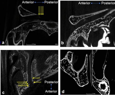 Integrity of walls of the infraorbital canal. a and b Sagittal view ...