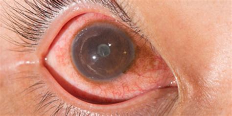 Symptoms, Causes and Treatment of Uveitis - Neoretina Blog