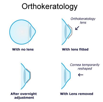 Ortho K or Orthokerathology - is it safe ? - Evershine Optical