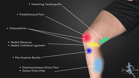 Knee Pain Location Chart | Learn the Pain Location of Knee Injuries