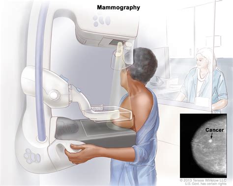 Mammography | ACS