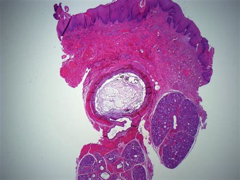 Mucocele Histology